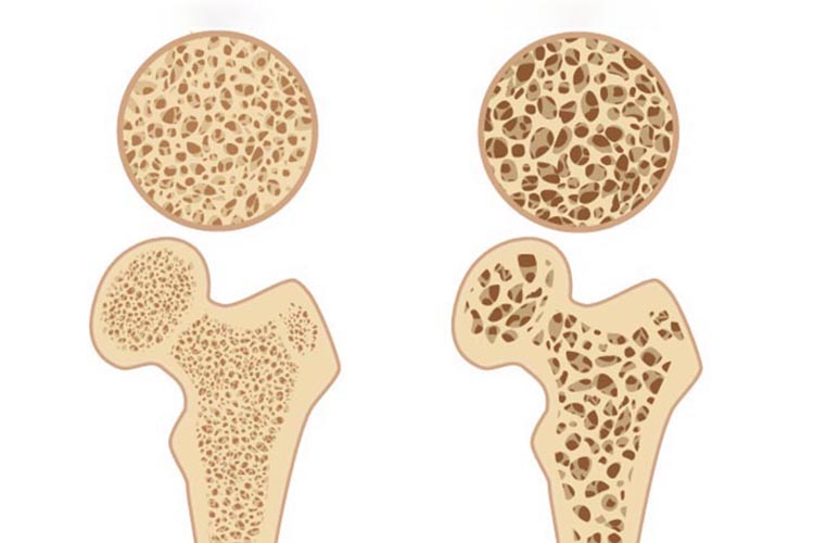 骨粗しょう症イメージ
